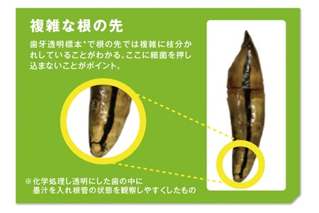 ＥＮＤＯ（エンド）治療