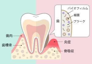 プラークとバイオフィルムによる歯茎の炎症と骨吸収の解説図