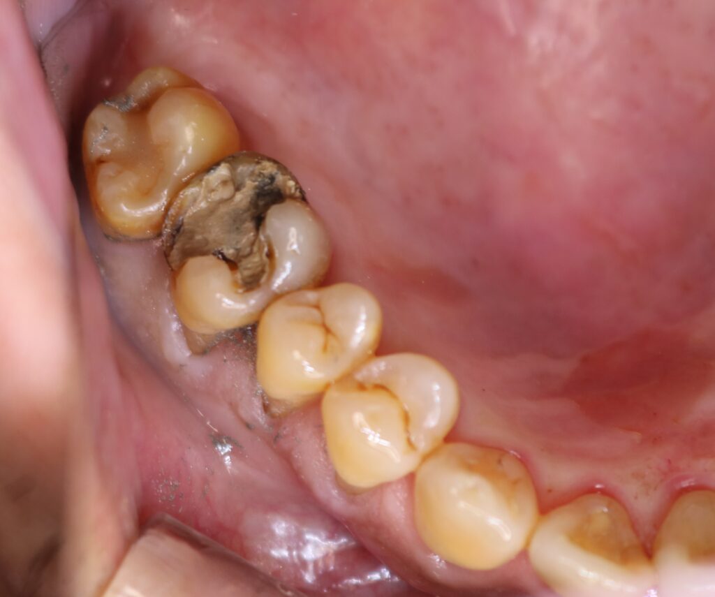 銀歯の下で進行した二次齲蝕の症例写真（インレー下の隙間と内部の虫歯）｜岐阜市 りお歯科クリニック