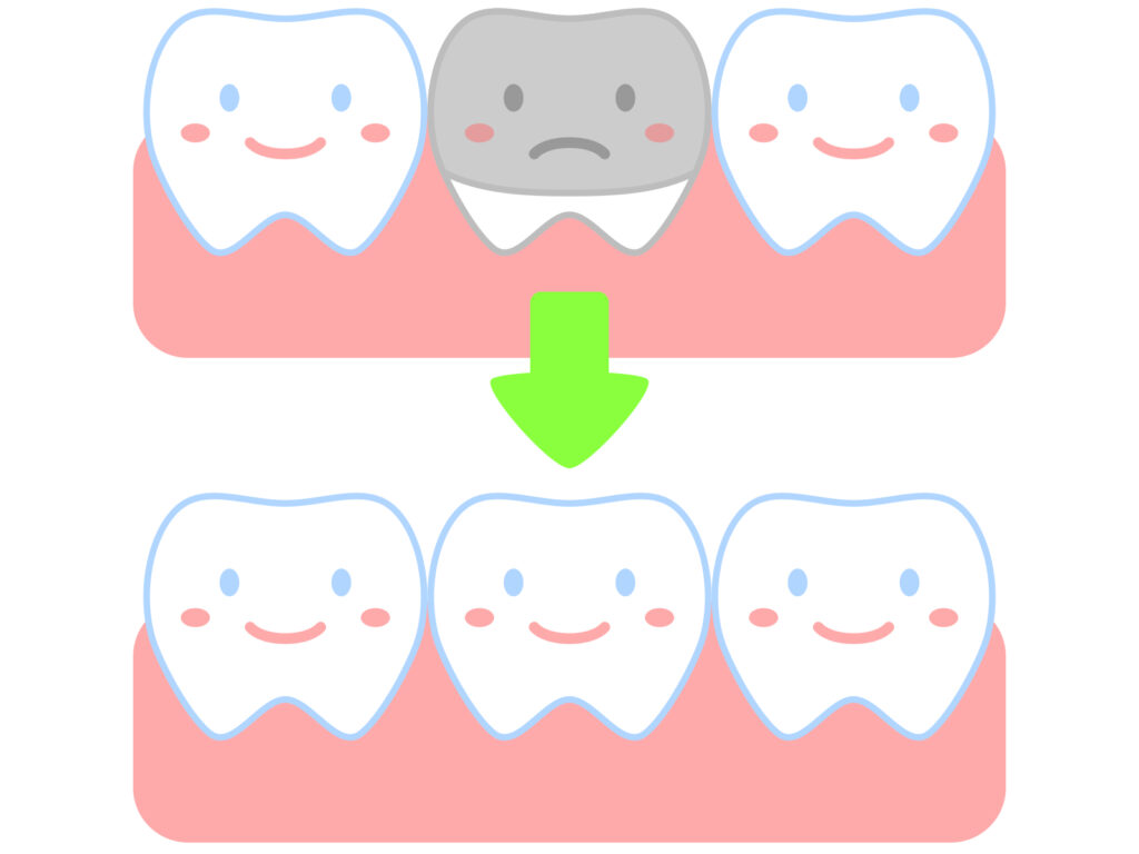 銀歯をセラミックへ変更｜岐阜市 りお歯科クリニック