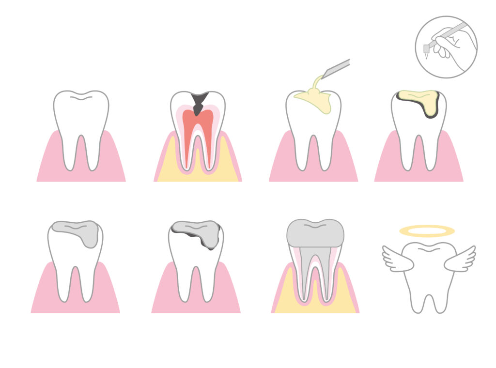 二次齲蝕を繰り返すことで歯を失う過程｜岐阜市 りお歯科クリニック